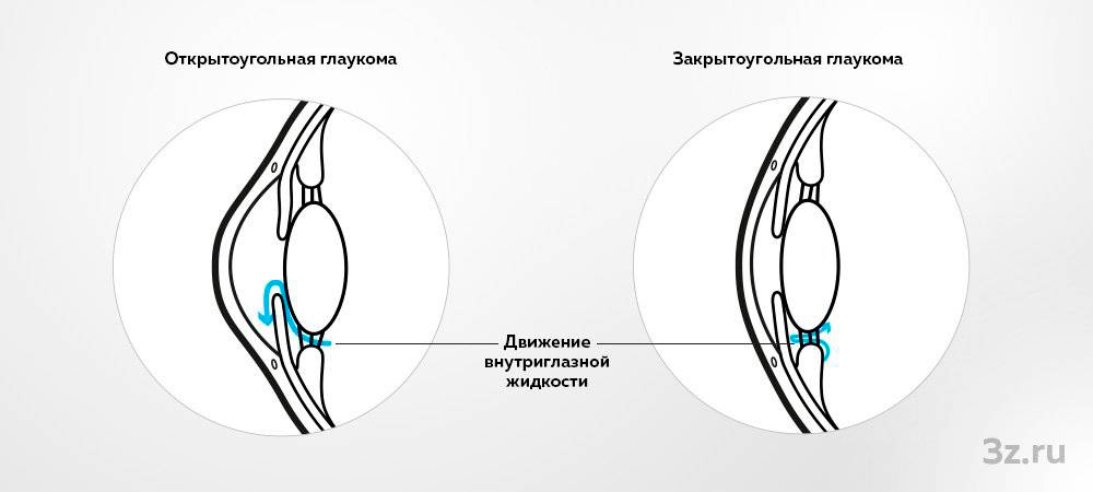 формы глаукомы
