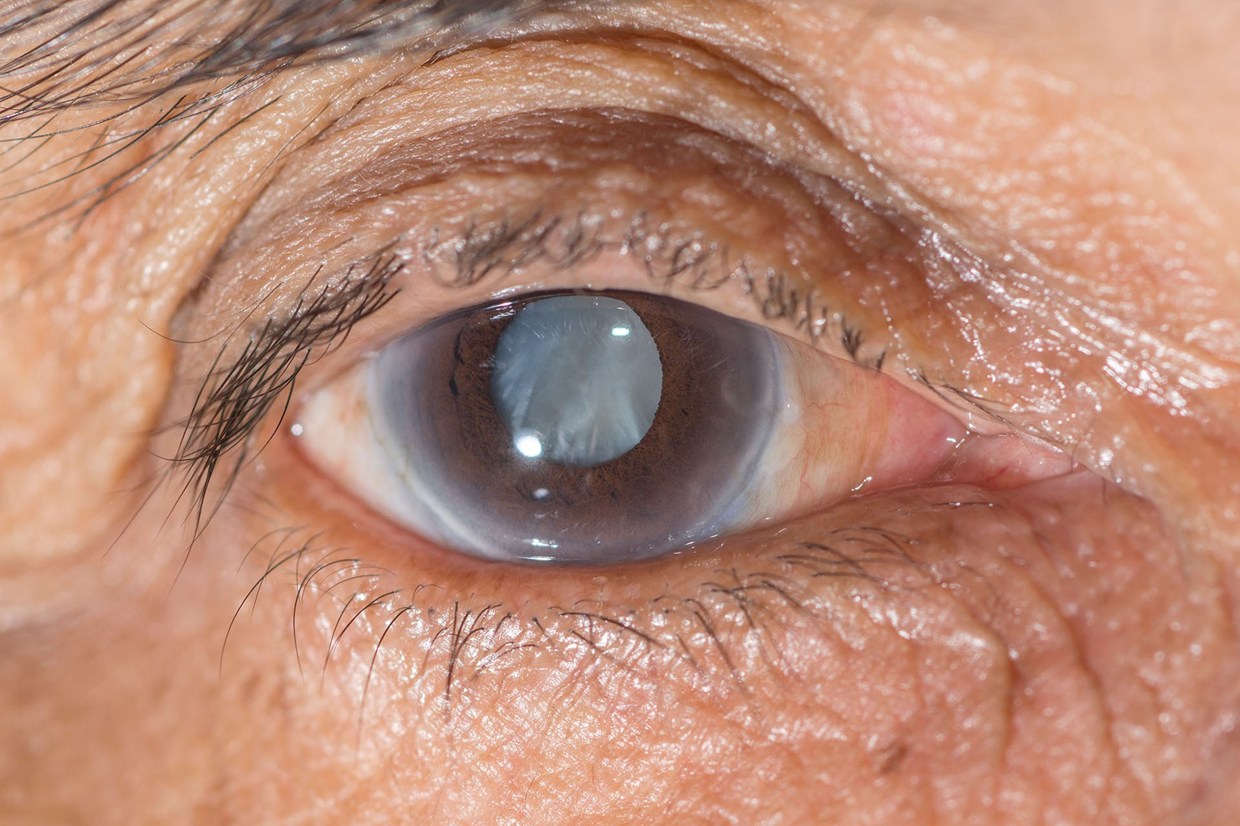 лечение глаукомы с помощью лазера