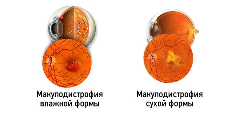 сухая и влажная макуладистрофия