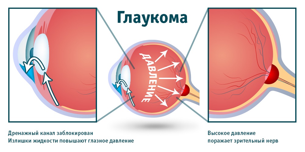 глаукома лечение лазером