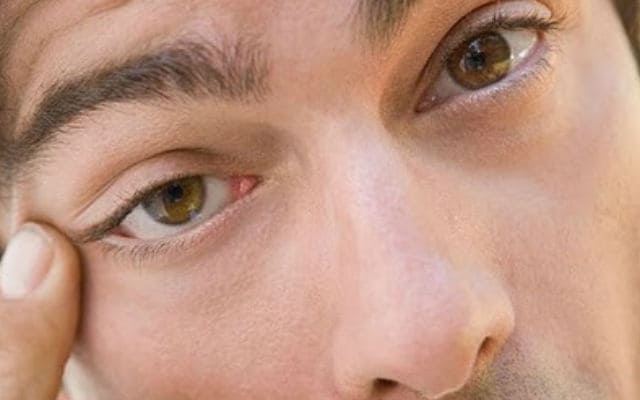 Почему дергается глаз: причины и способы лечения