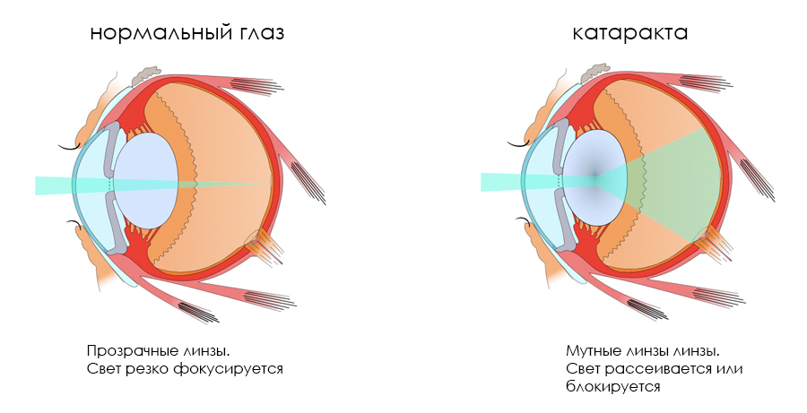 Признаки катаракты