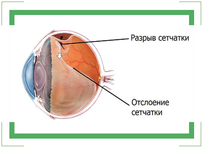 Разрыв сетчатки