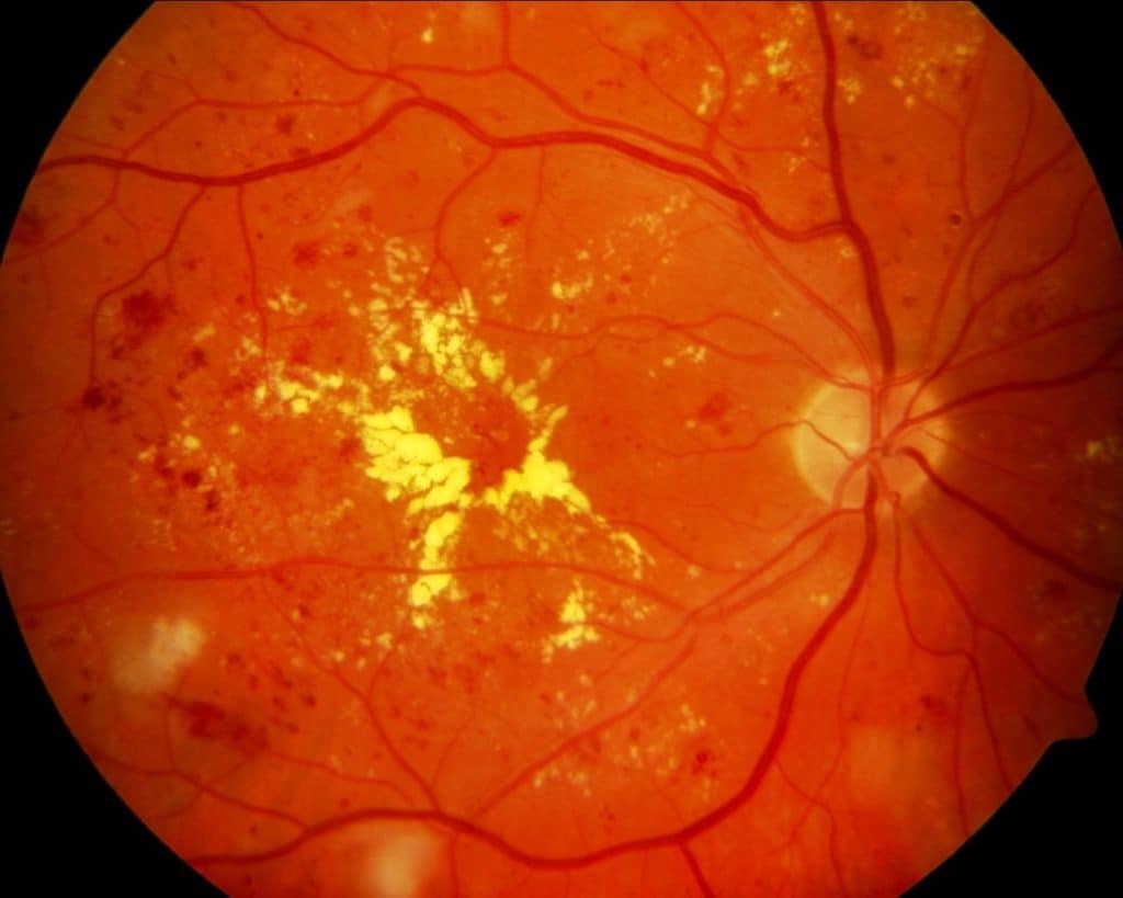 Виды и формы заболеваний сетчатки глаза