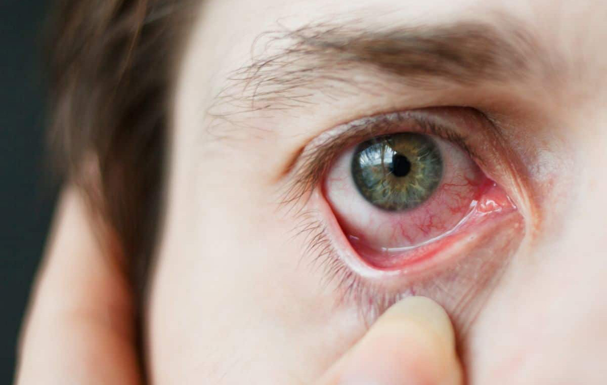 Причины высокого глазного давления