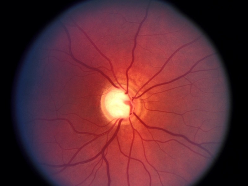 Атрофия зрительного нерва (оптическая нейропатия)