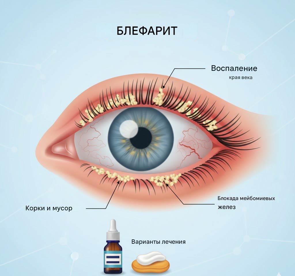 Блефарит лечение