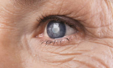 Хирургическое лечение катаракты глаза