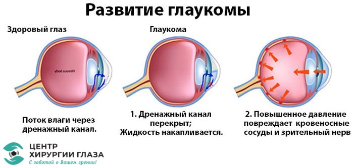 диагностика глаукома