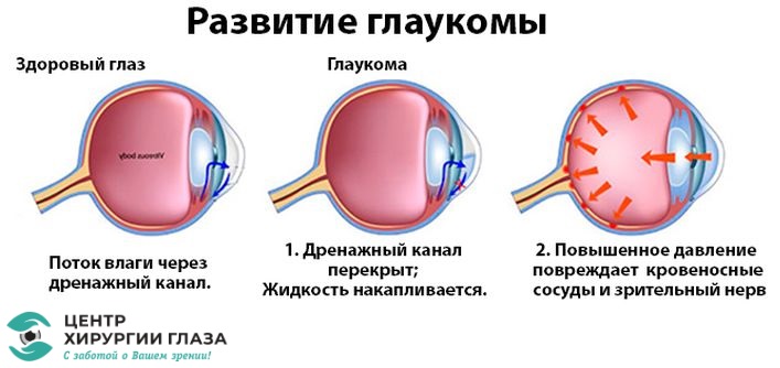 Глазное давление у детей. Этапы развития глаукомы. Глаукома схема глаза. Схема операции при глаукоме. Внутриглазное давление при стадиях глаукомы.