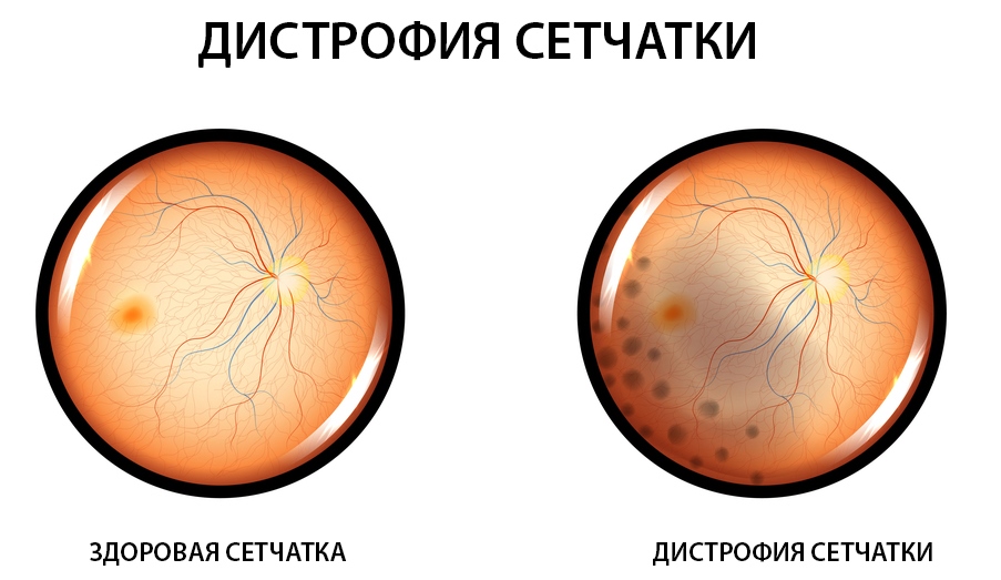 симптомы дистрофии сетчатки