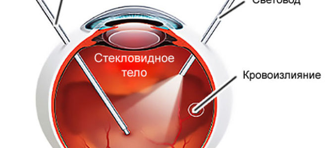 гемофтальм лечение
