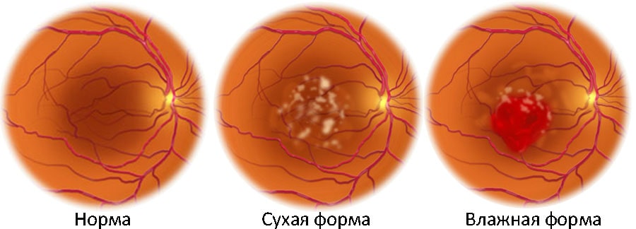 диагностика возрастной макулярной дегенерации
