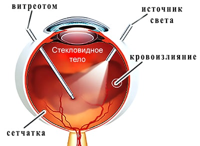 гемофтальм лечение