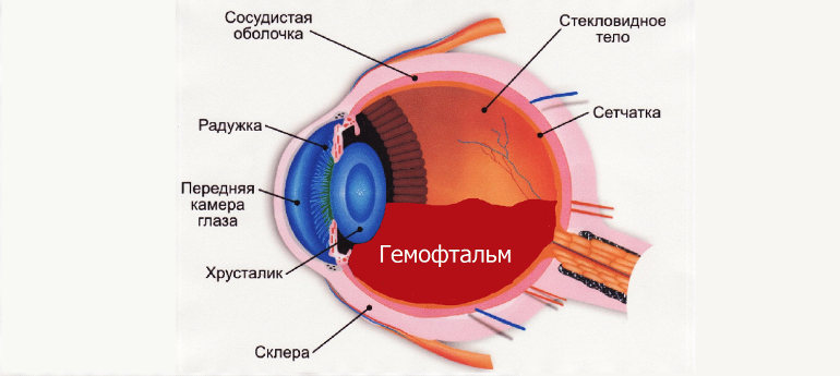 гемофтальм глаза лечение