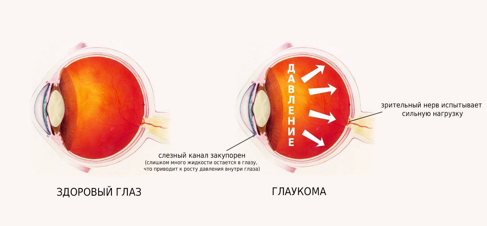 причины глаукомы