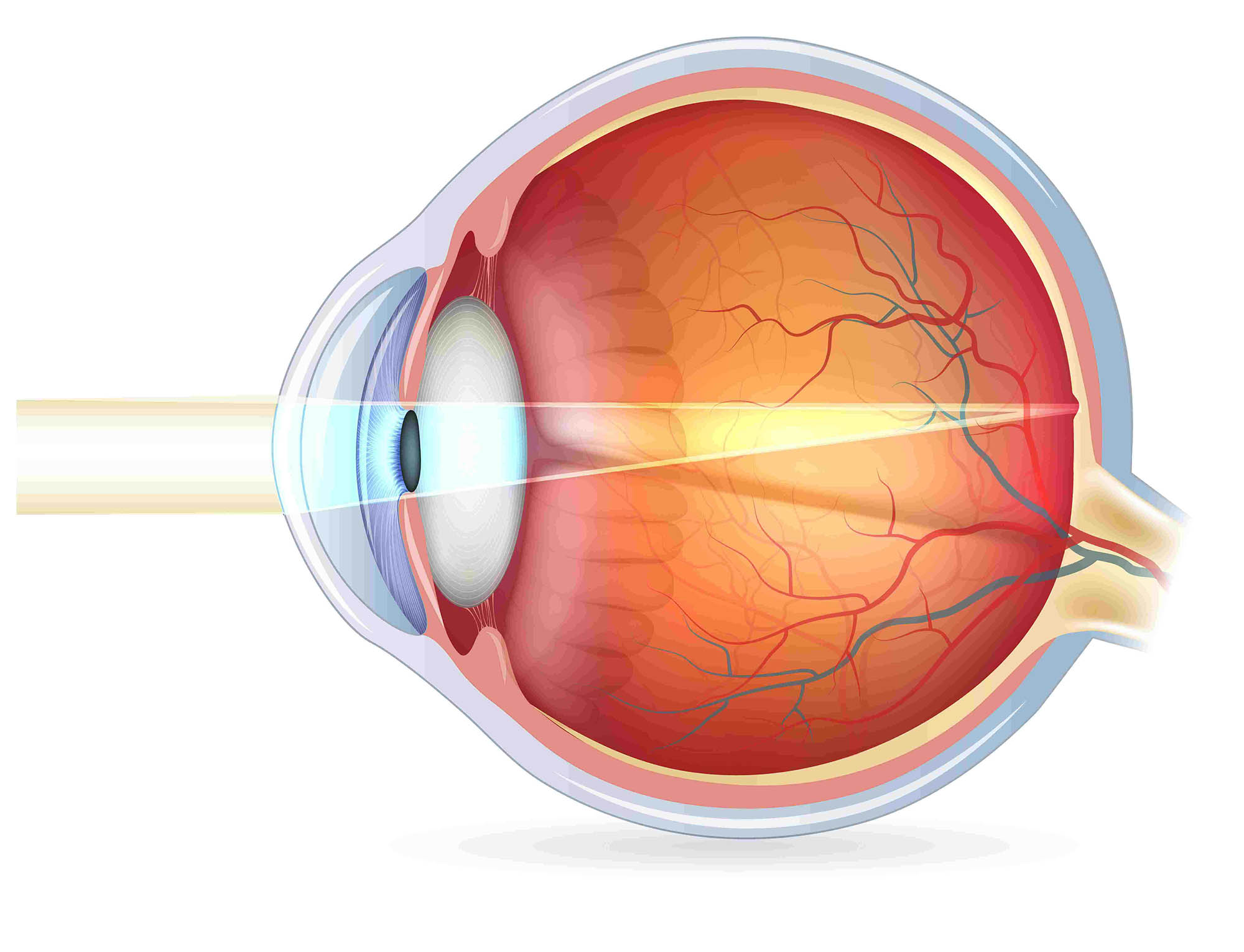 лазерное лечение гемофтальма глаза
