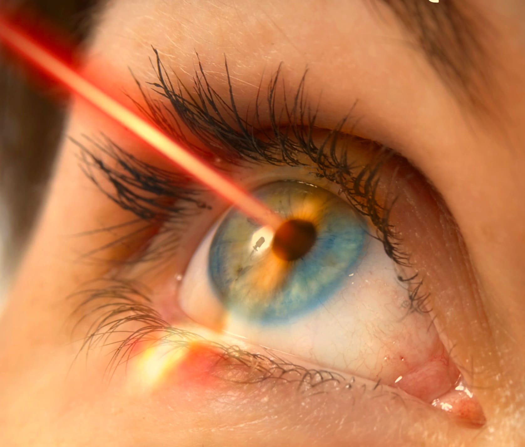 Лазерное лечение глаукомы – преимущества