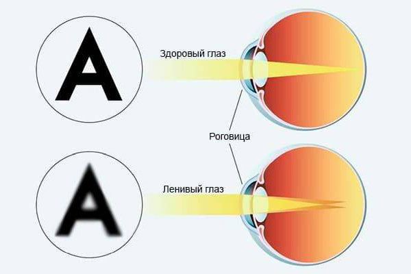 причины амблиопии