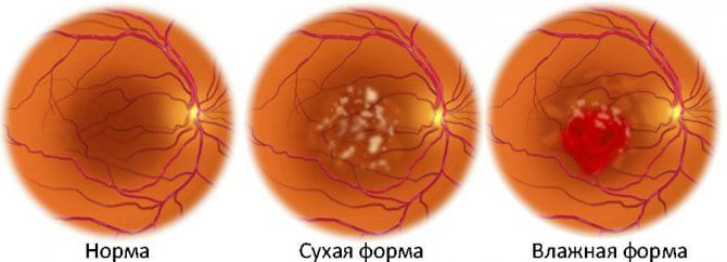 формы возрастной макулярной дегенерации