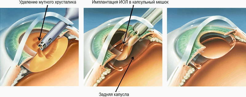 процесс удаления катаракты