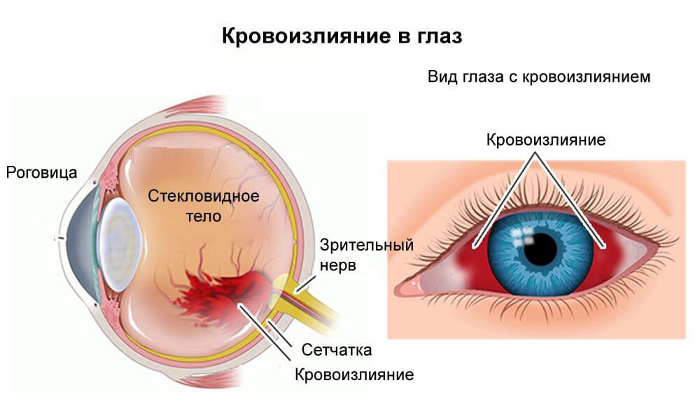 внутриглазное кровоизлияние