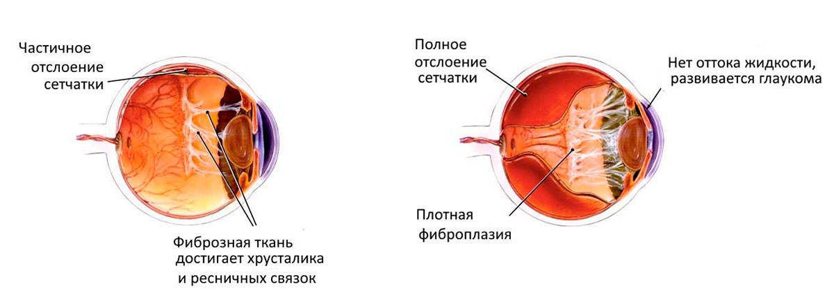 Пломбирование сетчатки. Отслойка сетчатки зрение. Глазное дно отслоение сетчатки. Глаз при отслоения сетчатки глаза. Регматогенная отслойка сетчатки глаза.