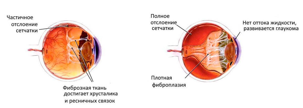 стадии остлойки сетчатки