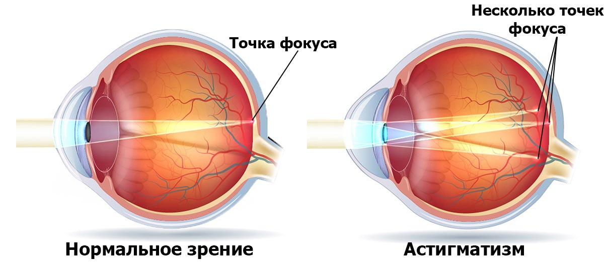 Астигматизм