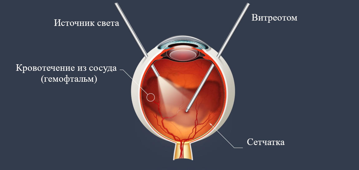 что такое гемофтальм