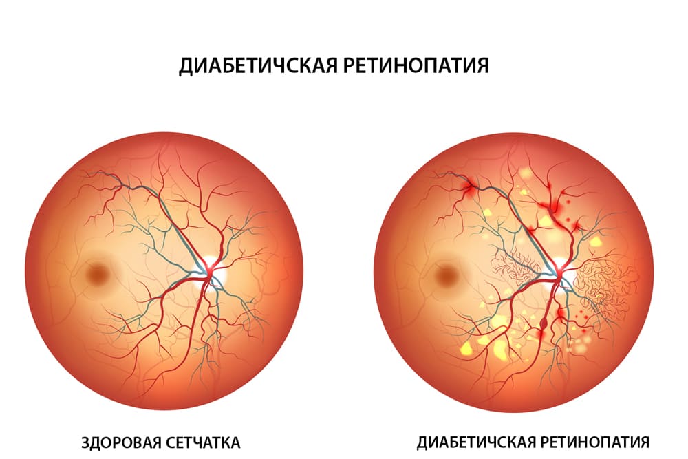 Диабетическая ретинопатия: причины возникновения и симптомы
