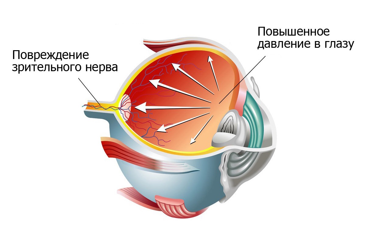 глаукома