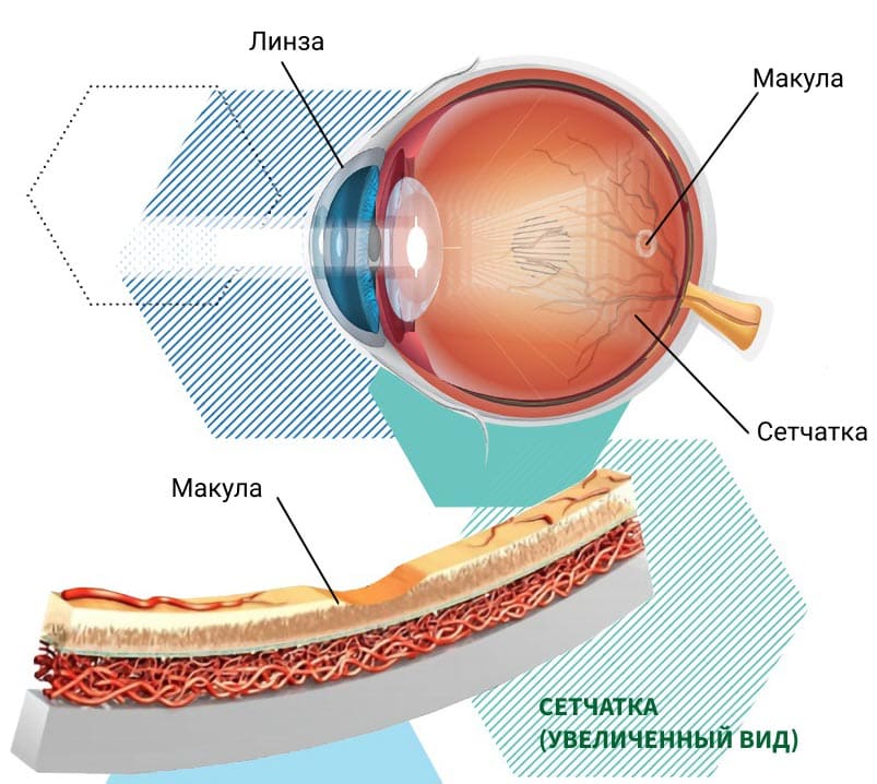 лечение возрастной макулярной дегенерации