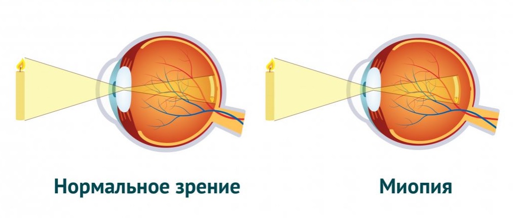 Миопия