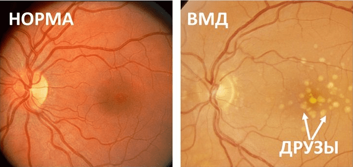 особенности лечения ВМД