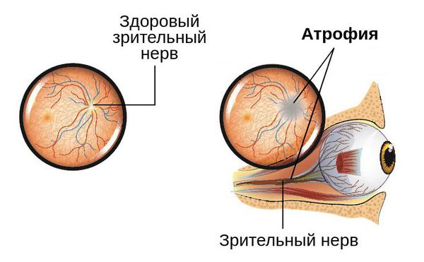 Патогенез атрофии зрительного нерва