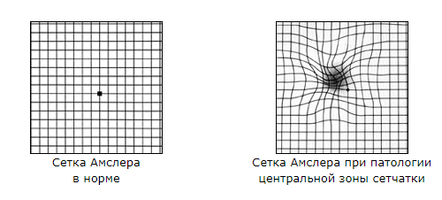 диагностика ВМД