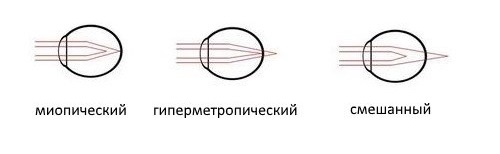 Виды астигматизма