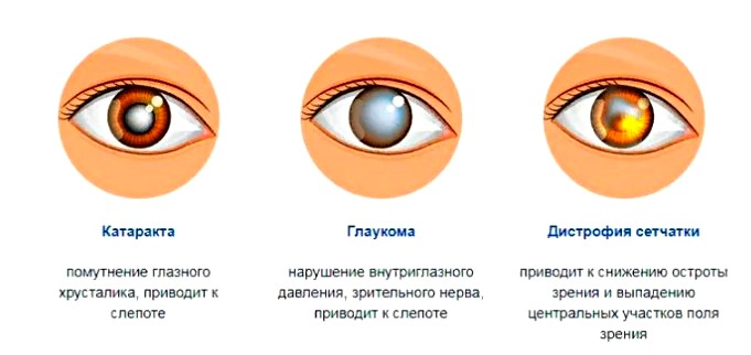Виды-глазных-заболевании