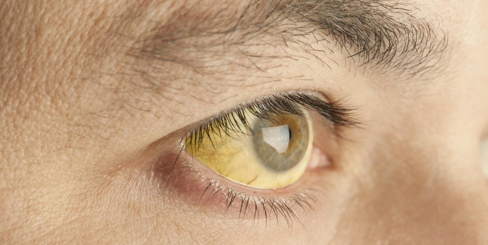 желтые белки глаз