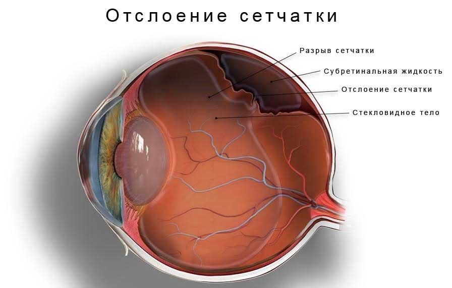 отслоение сетчатки