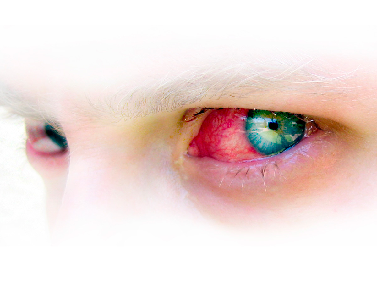 Первая помощь при контузии глаза