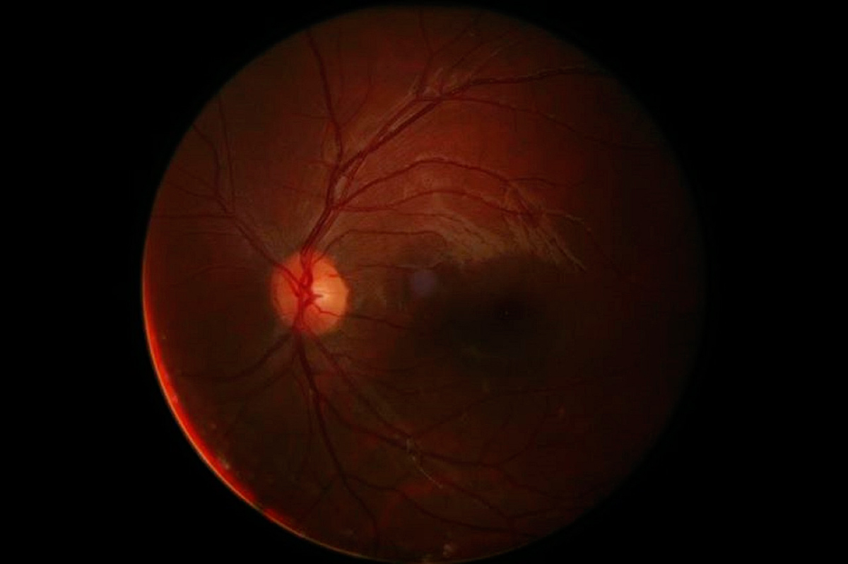 лечение глаукомы