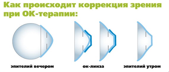 подбор жестких ортокератологических линз
